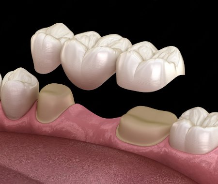 Dental implant
