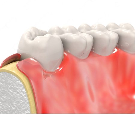 Dental implant